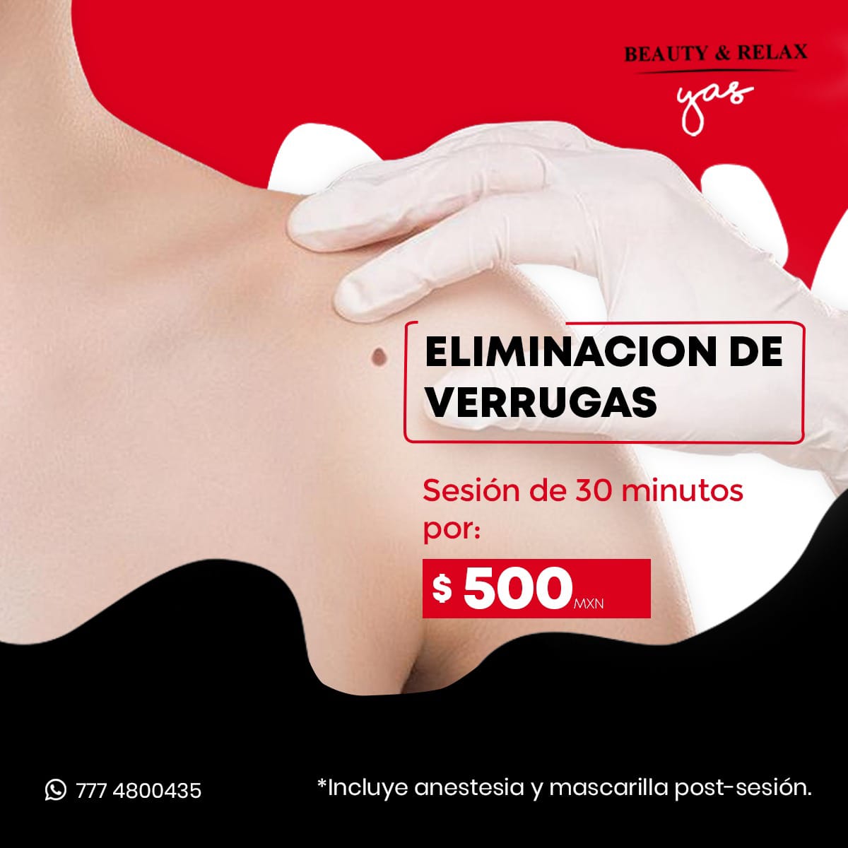 Eliminación de Verrugas (Por zona/sesión)